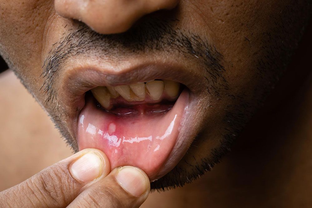 嘴巴破洞急救指南：吃什麼讓口腔傷口迅速痊癒